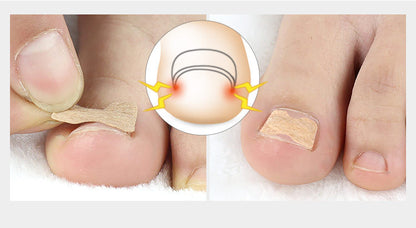 PARCHE PARA UÑAS ENCARNADAS, ADIÓS HONGOS