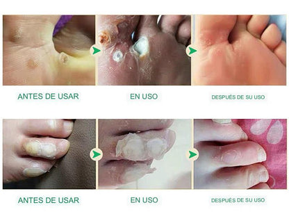 GEL ANTI-HONGOS Y CALLOS + ENVÍO GRATIS